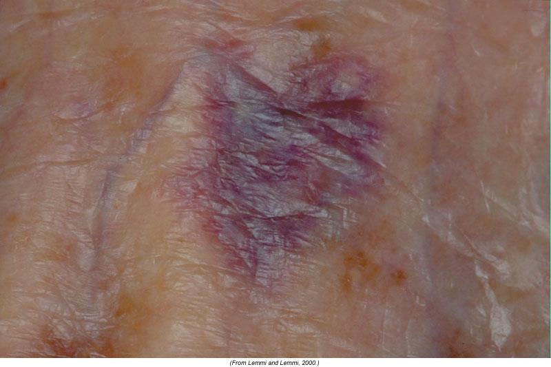 Properly identifying the cause and type of a patient’s skin condition involves a process of elimination known as differential diagnosis. Using this process, a health professional can take a given set 1