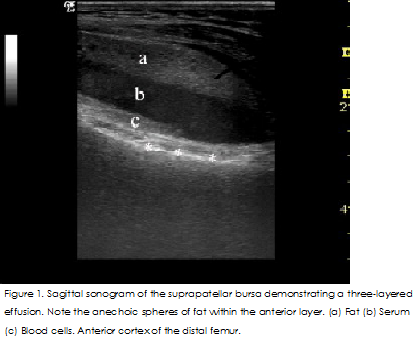 Lipohaemarthosis of the knee 1