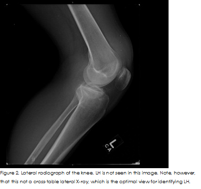 Lipohaemarthosis of the knee 2