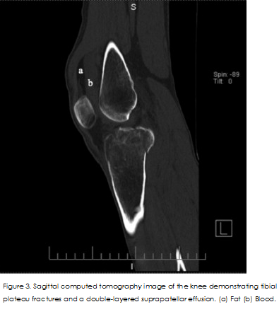 Lipohaemarthosis of the knee 3