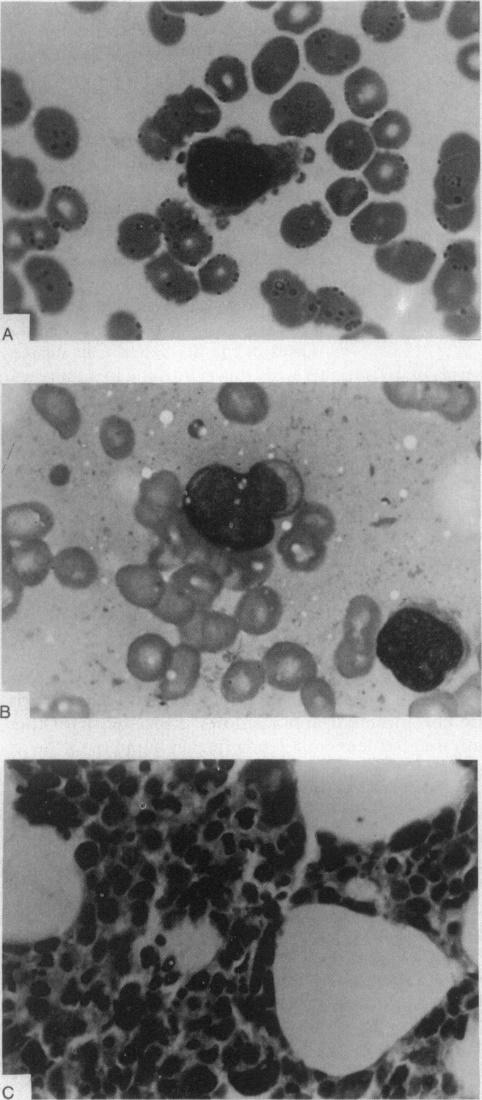 Diagnosis advancement in haematological Neoplas ADVANCES IN THE LABORATORY DIAGNOSIS OF HAEMATOLOGICAL NEOPLASM 2